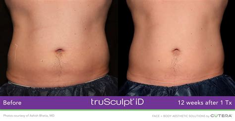 trusculpt id near me